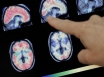 Australia has Alzheimer's therapy breakthrough
